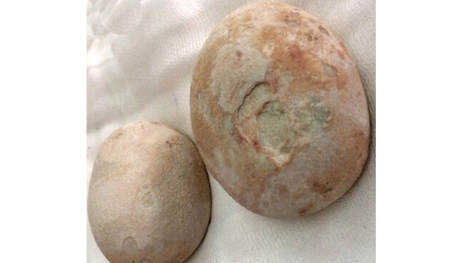 Hai viên sỏi có kích thước hiếm thấy. Ảnh: Bệnh viện cung cấp