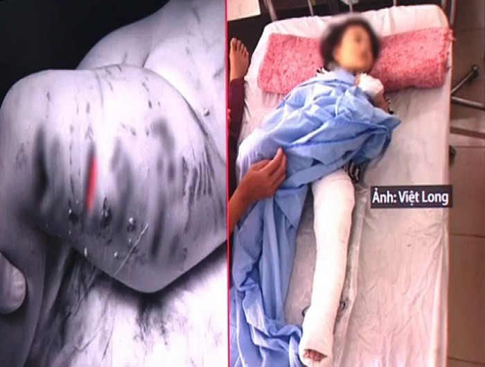 Bé gái nhập viện với thương tích nặng (nguồn: Việt Long)