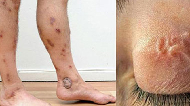 Có nguy cơ bị giun, sán, viêm loét tay chân do vệ sinh không sạch