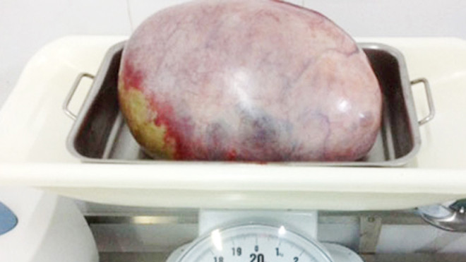 Khối u buồng trứng nặng gần 5 kg trong bụng thiếu nữ. Ảnh: Đ.X.