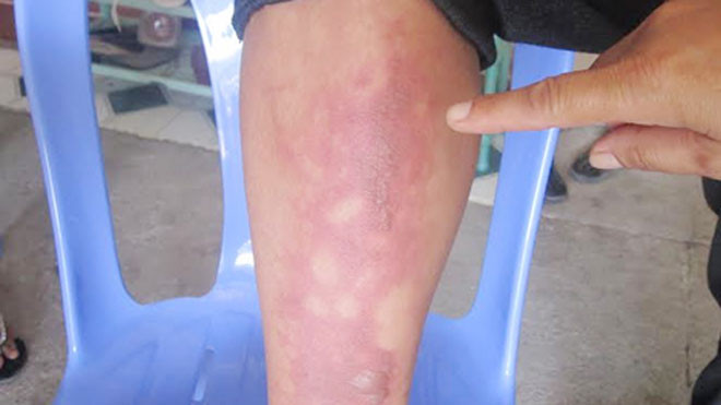 Chai xăng tự chế do các đối tượng quăng vào nhà gây bỏng phần chân anh Hùng.