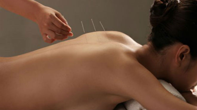 Trị bệnh béo phì bằng phương pháp châm cứu
