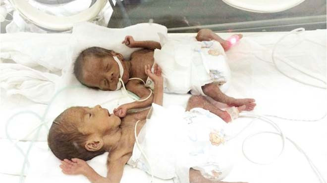 Chăm sóc trẻ sinh non cần một chế độ đặc biệt. (Ảnh cặp song sinh sinh non 500gr vừa được Bệnh viện Phụ sản Trung ương nuôi thành công).