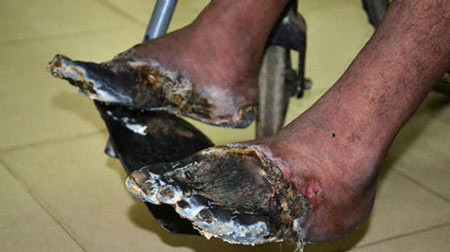 Người sống bị chết khô 2 chân vì hút nhiều thuốc lá 