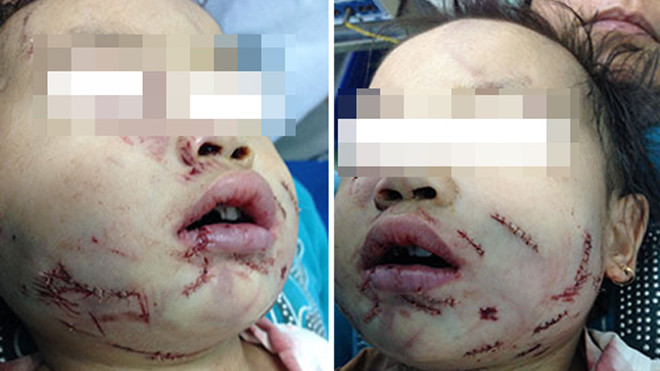 Gương mặt của bé sau khi được khâu vá các vết thương. Ảnh: Bác sĩ Minh Hằng