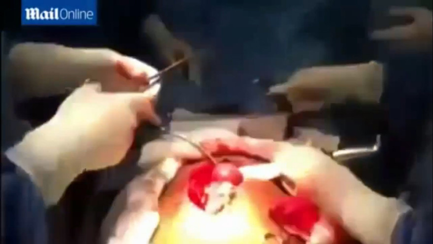 Kinh hãi cá dài hơn 1 mét trong bụng người