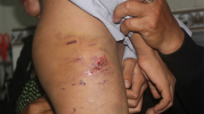 Vết đánh trên đùi, mông em Nui 