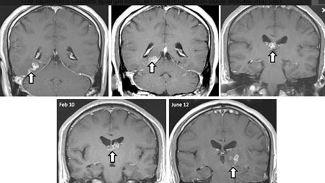 Hãi hùng sán lạ 'tung tăng' trong não suốt 4 năm