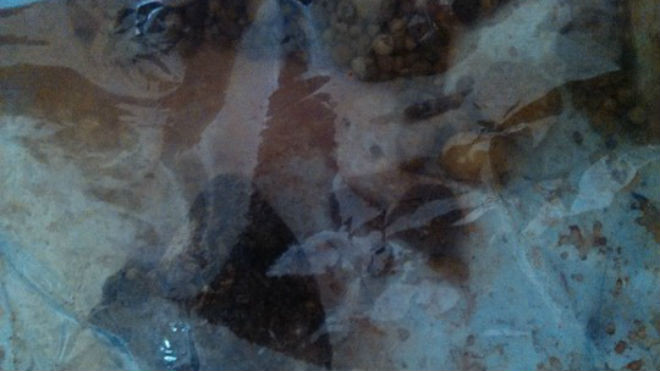 Những viên sỏi được lấy ra từ thận của cụ Nguyễn Thị Đẹp