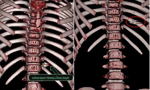 Hình ảnh chụp 3D lồng ngực cho thấy mảnh đạn găm trong ngực bé gái. Ảnh: Hà Trang