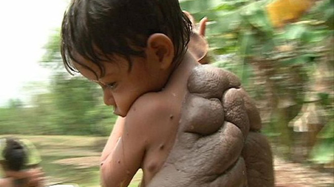 Didier Montalvo và khối u khổng lồ sau lưng