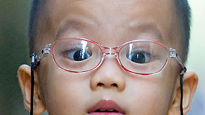 Khắc phục loạn thị cho con không cần đeo kính