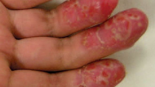 Bệnh viêm da cơ địa.