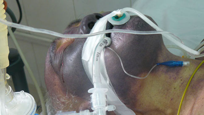 Bệnh nhân bị nhiễm liên cầu khuẩn lợn tại khoa cấp cứu, BV bệnh Nhiệt đới TW.