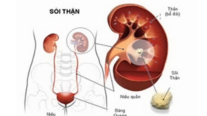Những biến chứng của bệnh sỏi thận