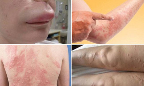 Xử lý các tình trạng da bị ngứa, cước, nẻ, nổi mề đay ngày lạnh