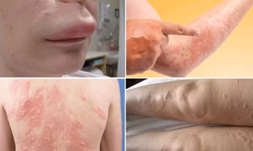 Xử lý các tình trạng da bị ngứa, cước, nẻ, nổi mề đay ngày lạnh
