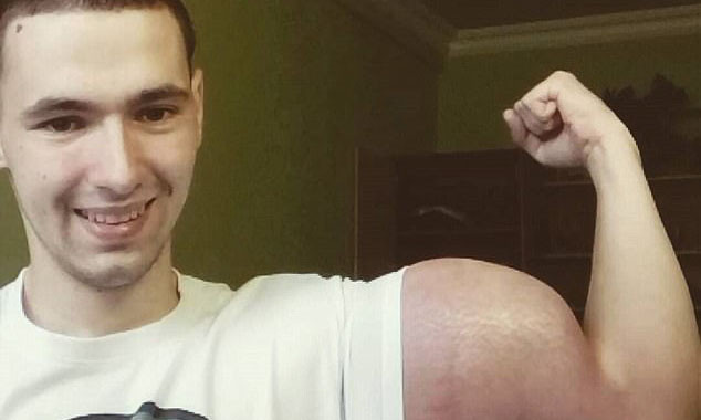 Bắp tay biến dạng của Tereshin sau khi tiêm synthol. Ảnh: Cen.