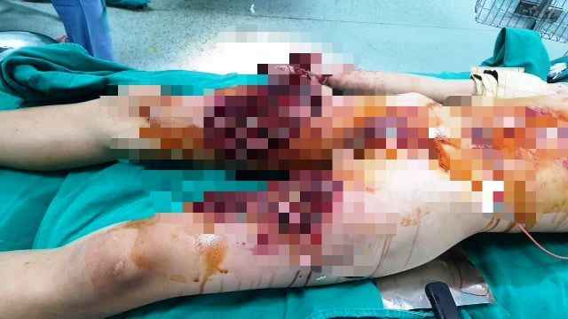 Học sinh bị nát bàn tay do làm pháo