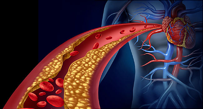 Tiểu đường, mỡ máu được coi là hai “sát thủ” âm thầm đối với người bệnh.