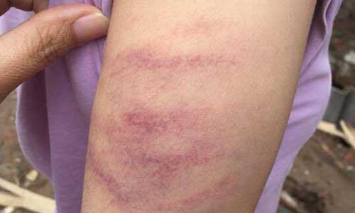 Một học sinh ở Trường tiểu học Mễ Trì, Từ Liêm, Hà Nội bị giáo viên đánh bầm tay vì không làm đủ bài tập