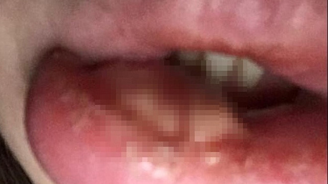 Môi bị sưng phồng sau khi tiêm botox của Sally. Ảnh: Daily Mail.