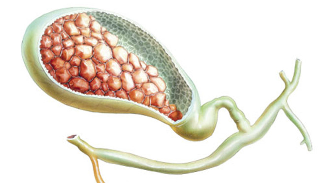4 triệu chứng phố biến của bệnh sỏi mật