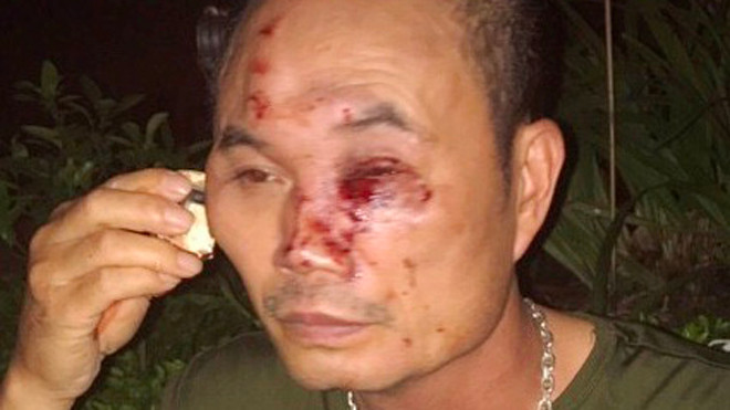 Anh Hảo bị côn đồ đánh rách mặt.