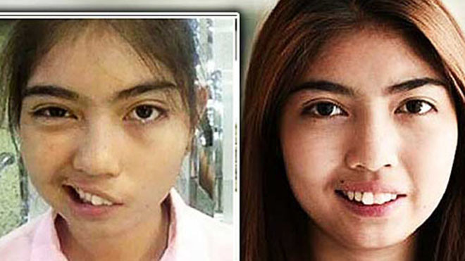 Naruedee Jotsanthia bị méo miệng và không nhắm được mắt sau khi bị thầy giáo dạy thể dục ném cốc vào đầu. Ảnh: AFP