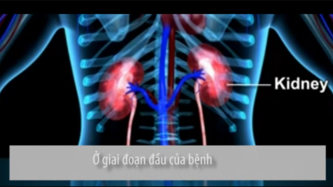 Tại sao một người phải chạy thận nhân tạo?