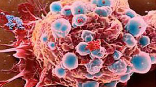 Tế bào ung thư ngày càng phát triển