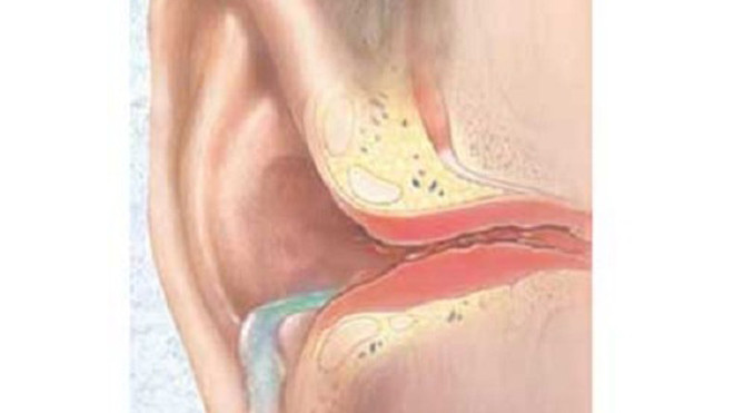 Viêm tai do đi bơi gia tăng khi hè về.