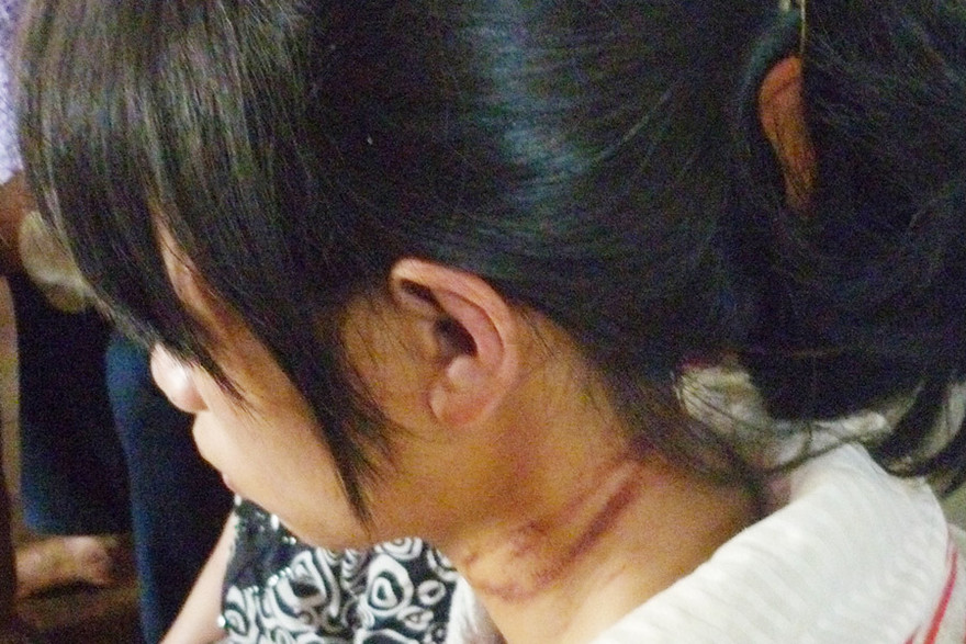 Vết thương trên cổ cháu Linh.