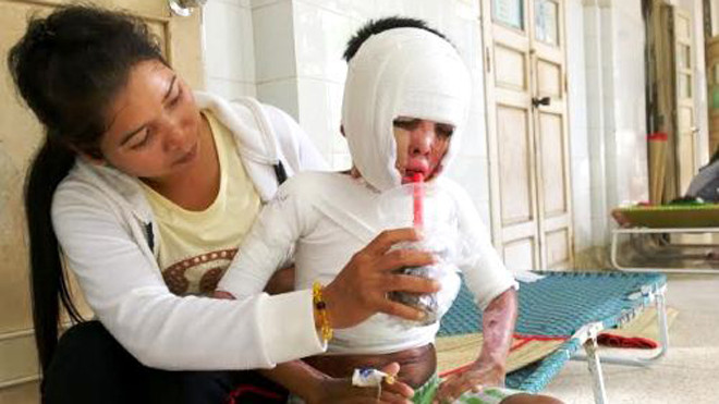 Được chữa trị tại Bệnh viện Nhi đồng 2, bệnh nhi đã qua cơn nguy kịch, uống được nước và ăn cháo lỏng, đang chờ phẫu thuật ghép da. Ảnh: Thi Ngoan.