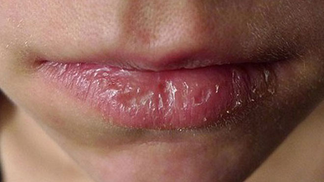 Môi của bệnh nhân bị kích ứng cho sử dụng son kém chất lượng. Ảnh: TH.