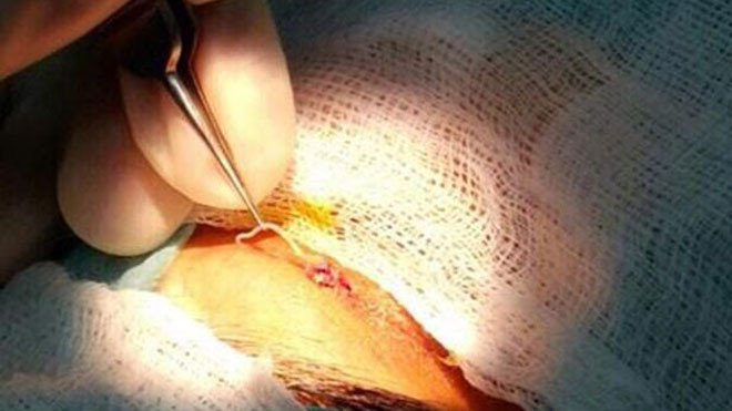 Bác sĩ đang gắp con giun ra khỏi mắt bệnh nhân nữ. Ảnh: Aster Hospital.