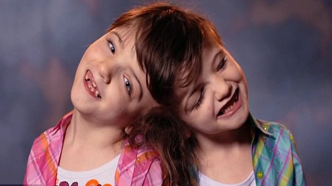 Bác sĩ nói Tatiana và Krista Hogan chỉ có thể tồn tại trong thời gian ngắn, song các em đã tạo nên kỳ tích khi sống bình thường trong 7 năm qua. Ảnh: Channel 5