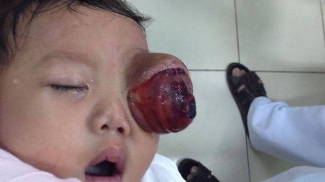 Bệnh nhi gặp căn bệnh quái ác đã được các bác sĩ điều trị thành công