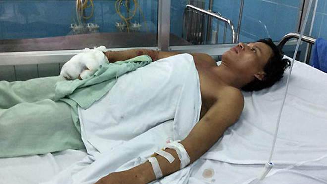 Bệnh nhân có nguy cơ phải cắt bỏ cẳng bàn tay vì bị hoại tử. Ảnh: Long Nhật. 