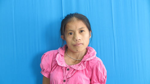 Vi Thị Phú mắc dị tật xương hàm, khớp cổ lệch, vẹo cột sống và dị tật tai