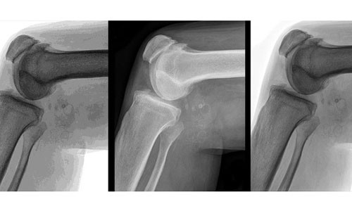 Cân nặng của một người khi nhỏ thực sự tác động tới viêm khớp hông, khớp gối nhiều hơn so với cân nặng khi trưởng thành.
