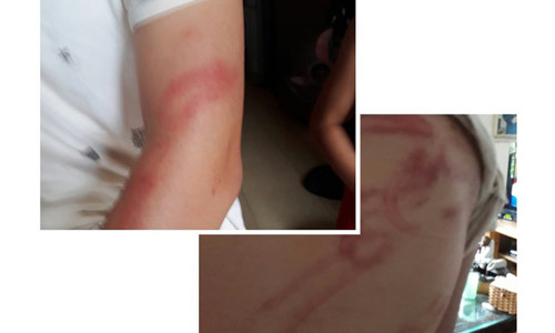 Thương tích trên người cháu P..