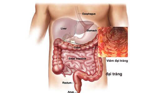 5 dấu hiệu giúp tự nhận biết sớm ung thư đại trực tràng