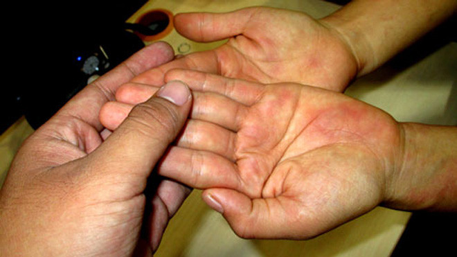 Một trường hợp tổn thương da khiến người bệnh lầm tưởng là những dấu xuất huyết dưới da nhưng thật ra là bị đỏ da do dị ứng