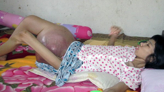 Cảm thương người phụ nữ có khối u nặng gần 10kg ở đùi