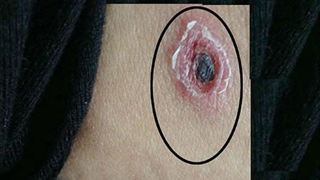 Vết loét to ở vùng bẹn do con mò cắn của bệnh nhân NTT nhưng ông và bác sĩ tuyến dưới không biết. Ảnh: TÙNG SƠN 