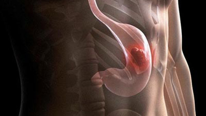 Nguy cơ tử vong do phát hiện muộn ung thư dạ dày