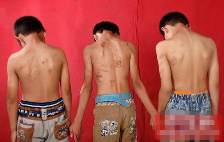 3 bé trai đã bị ép hiến máu. 