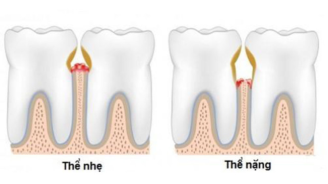 Những biến chứng nguy hiểm của bệnh viêm lợi