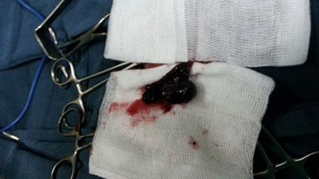 Buồng trứng hoại tử, mủn nát của bệnh nhi buộc phải cắt bỏ. Ảnh: bác sĩ cung cấp.